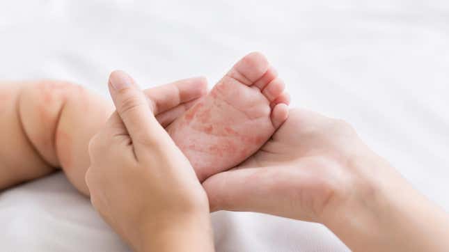 An example of the red rash that can be caused by measles infection.