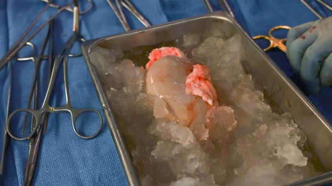 Slayman’s new pig kidney sitting on ice, about to be transplanted.