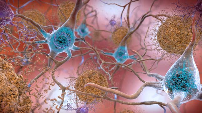 In the brain of a person with Alzheimer’s disease, beta-amyloid proteins clump together to form plaques (brown), while clumps of tau proteins form tangles (blue). These structures are thought to disrupt normal brain functioning.