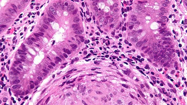A very high magnification micrograph of the colon in someone with Crohn’s disease.