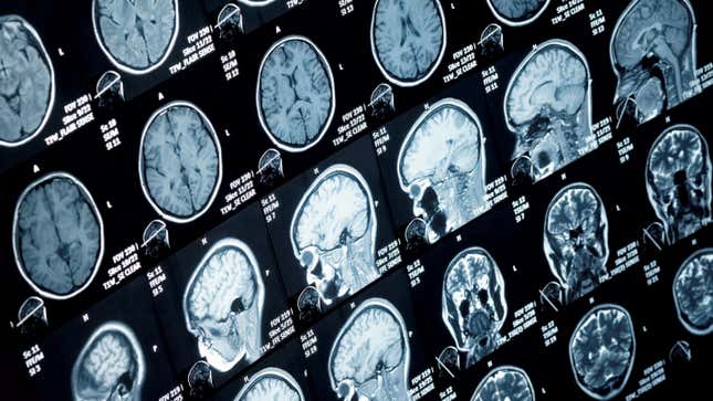 Head and neck MRI scans.