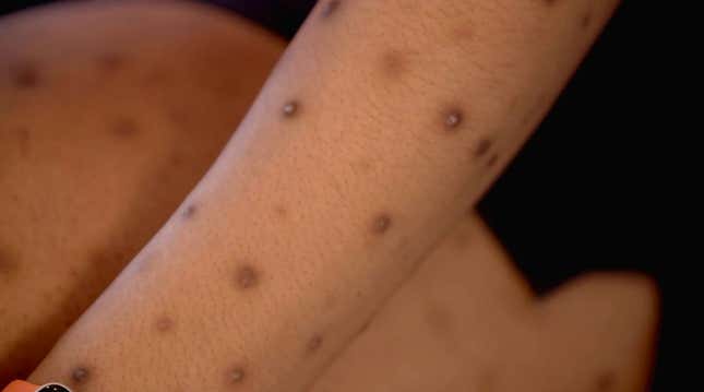 Image for article titled That's the Way the Pilar Cyst Bounces on Dr. Pimple Popper