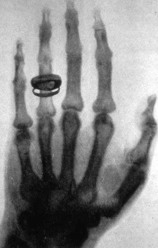 Bir insan elinin Wilhelm Röntgen tarafından çekilen ilk röntgen görüntüsü.
