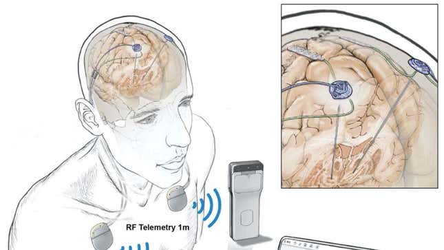 An illustration of the team’s wireless deep brain stimulation technology. 