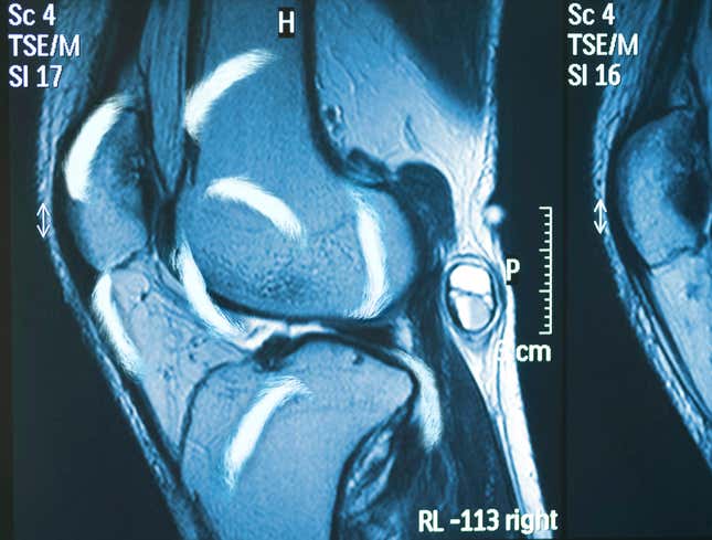 MRI Reveals Anthony Davis' Knee Filled With More Eyebrows