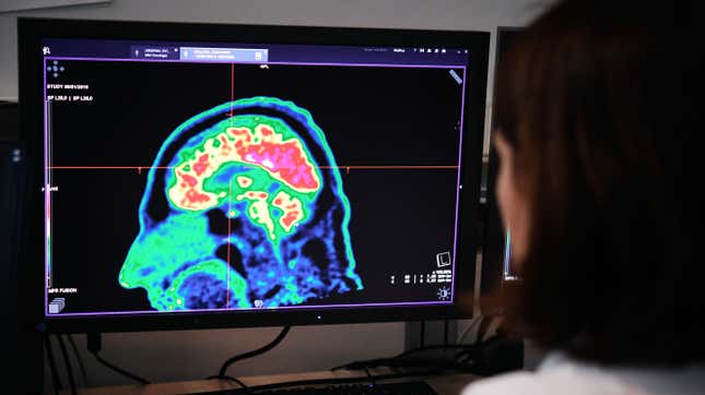 A doctor looking at a picture of a human brain taken by a positron emission tomography scanner, also called PET scan, on Jan. 9, 2019, at the Regional and University Hospital Center of Brest in France. 