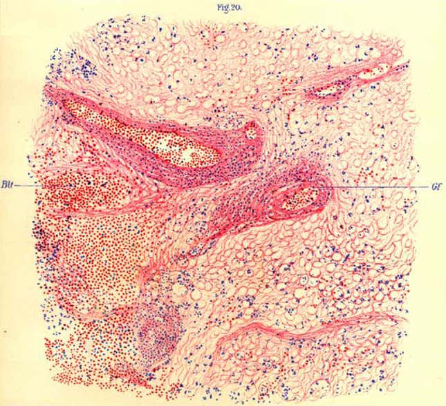 An illustration of brain tissue seen under a microscope that was collected from a monkey said to have encephalitis lethargica. The image was included in a book about the condition written by Austrian neurologist Constantin von Economo, who discovered it. 