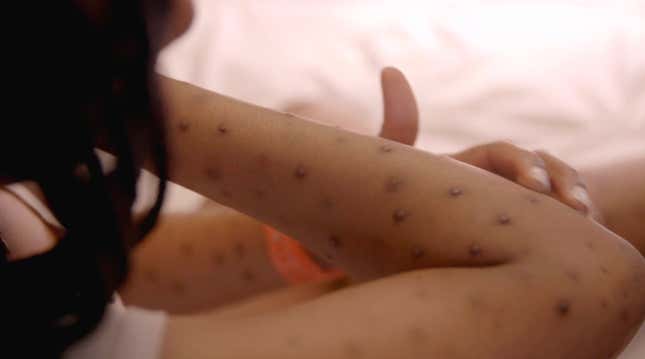 Image for article titled That's the Way the Pilar Cyst Bounces on Dr. Pimple Popper