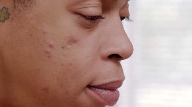 Image for article titled Dr. Pimple Popper and the Half-Head Removal