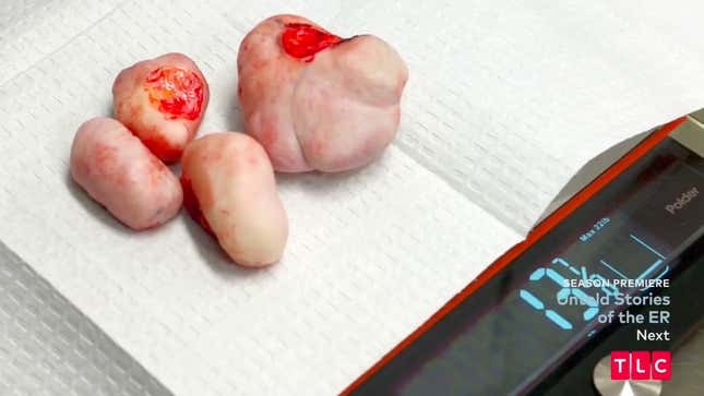 Image for article titled Dr. Pimple Popper's Season 3 Premiere Exposes the Dark Underside of Ear Piercing