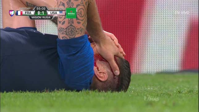 Olivier Giroud, Matt<em></em> Miazga Bloodied In Pre-World Cup Friendly<em></em>