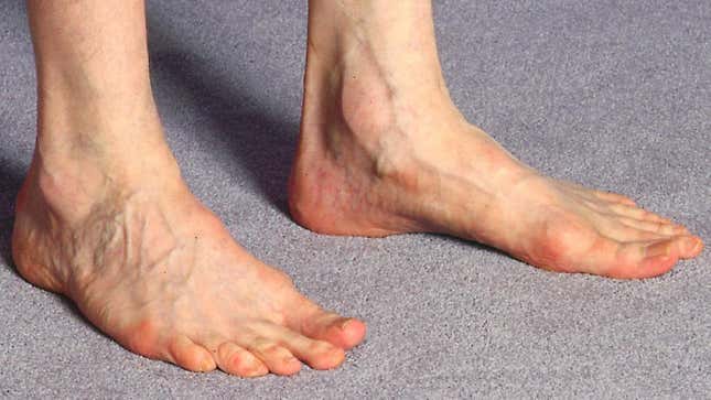 Image for article titled Anti-Vaxxers Are Harassing This Poor Woman Who Just Wants Treatment for Her Fucked Up Foot