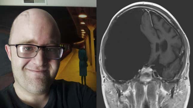 Tyler Leggett in August 2020 (left); the MRI scan of his brain that revealed the large cyst, taken in 2016 (right). Leggett’s doctors say the cyst has not changed in size since then. 