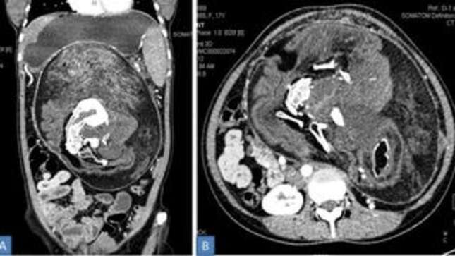 A CT scan of the fetus in fetu found inside the woman’s abdomen