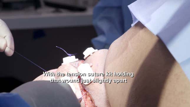 Image for article titled Dr. Pimple Popper and the Half-Head Removal