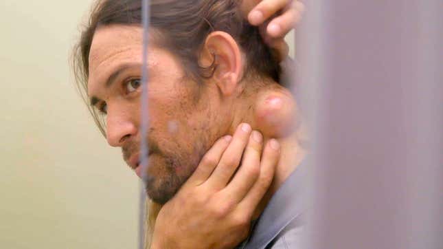 Image for article titled Dr. Pimple Popper and the Half-Head Removal