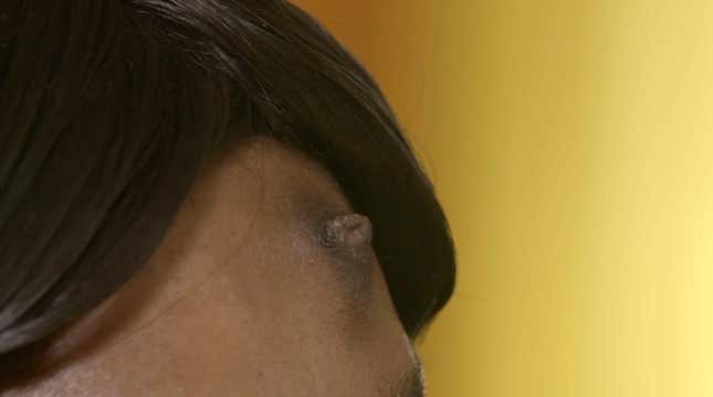 Image for article titled Dr. Pimple Popper Goes Head-to-Head With a Nipple... on Someone's Head
